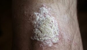 22842 plaque psoriasis