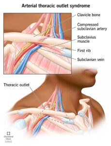 23004 arterial thoracic outlet syndrome