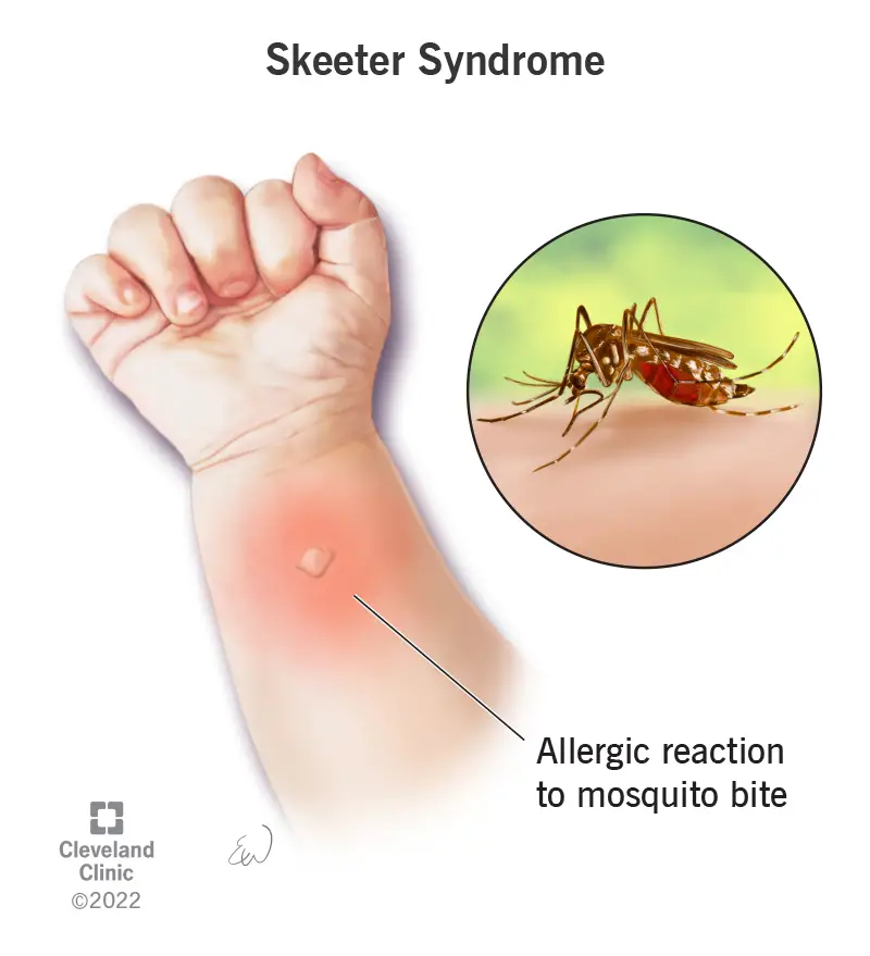 Skeeter sindroms, alerģiska reakcija uz odu siekalām, kas jūs iekož, rada kamolu, ko ieskauj pietūkums.