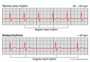 23349 bradyarrhythmia