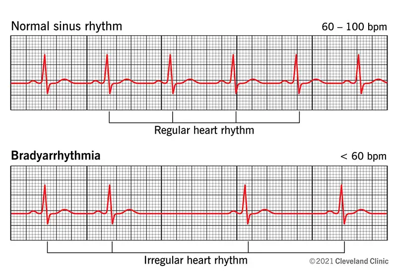 23349 bradyarrhythmia