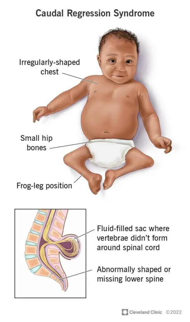 23425 caudal regression syndrome