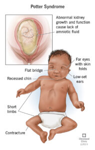 23584 potter syndrome