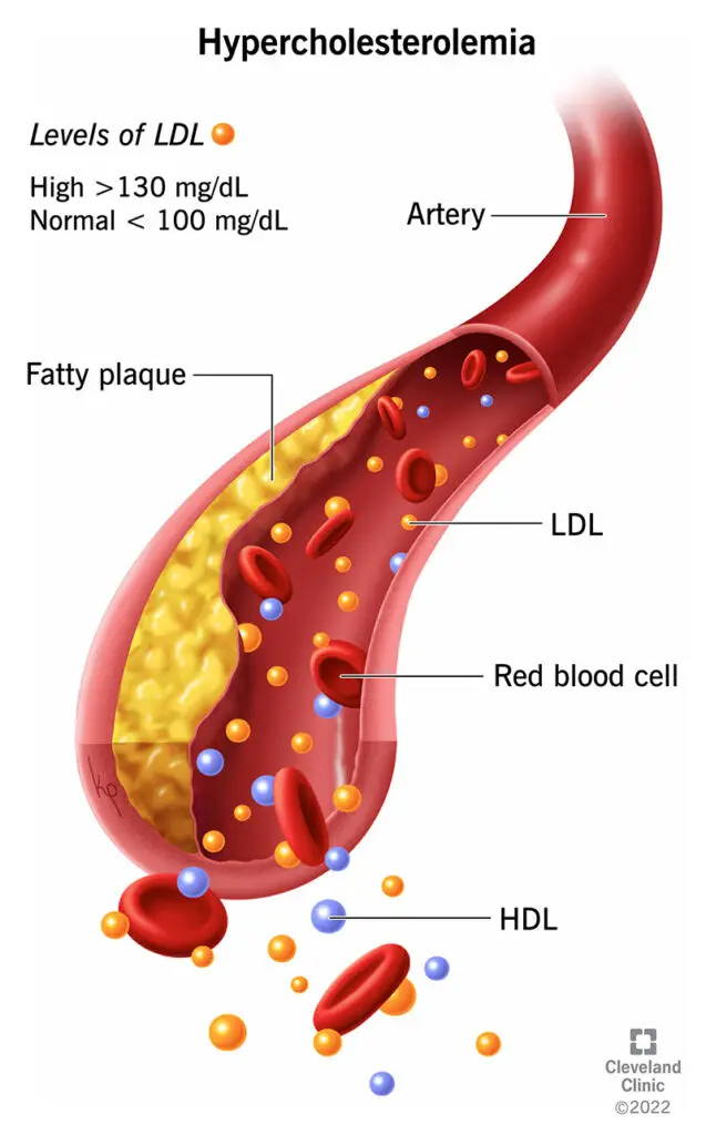 23921 hypercholesterolemia