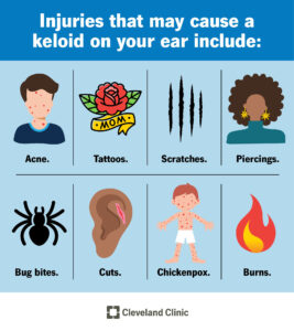 24047 keloid on ear