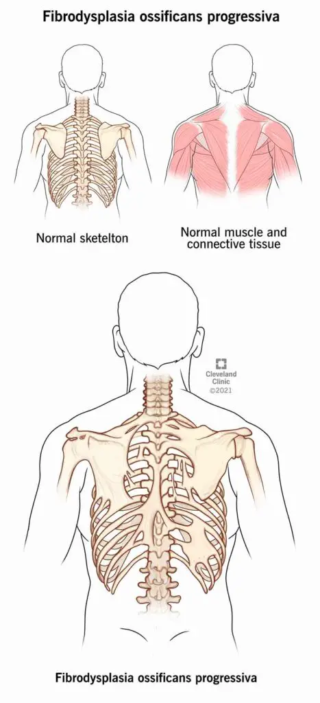 24476 fibrodysplasia ossificans progressiva