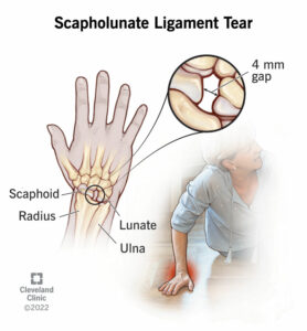 24558 scapholunate ligament tear