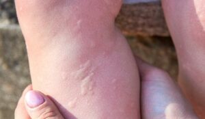 24629 cold urticaria