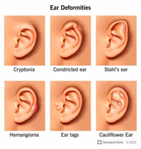 24904 ear deformities