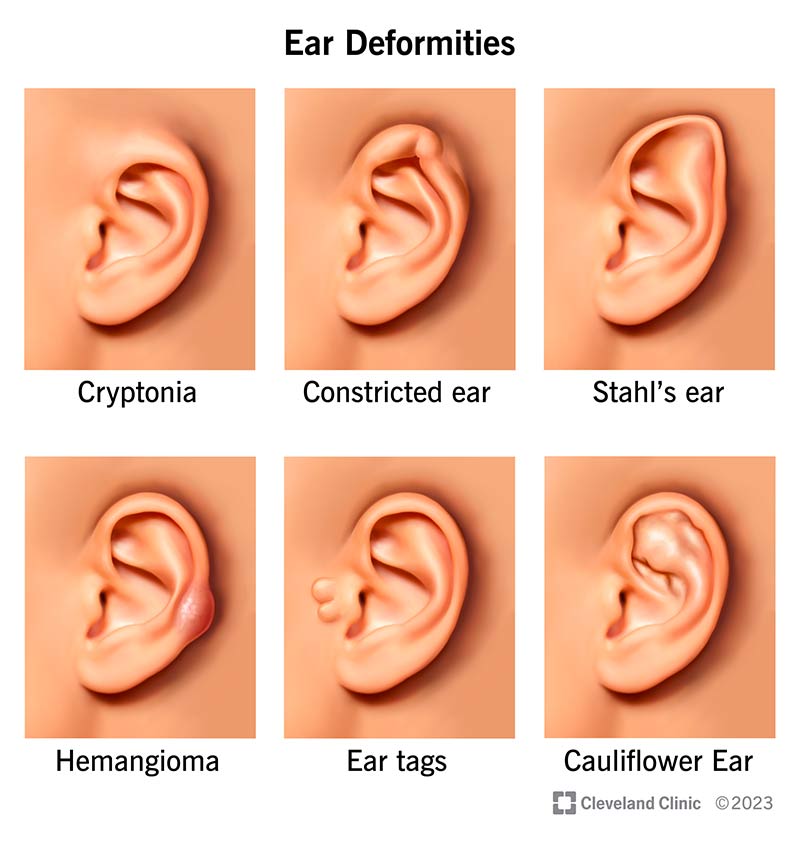 24904 ear deformities