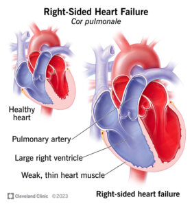 24922 right sided heart failure