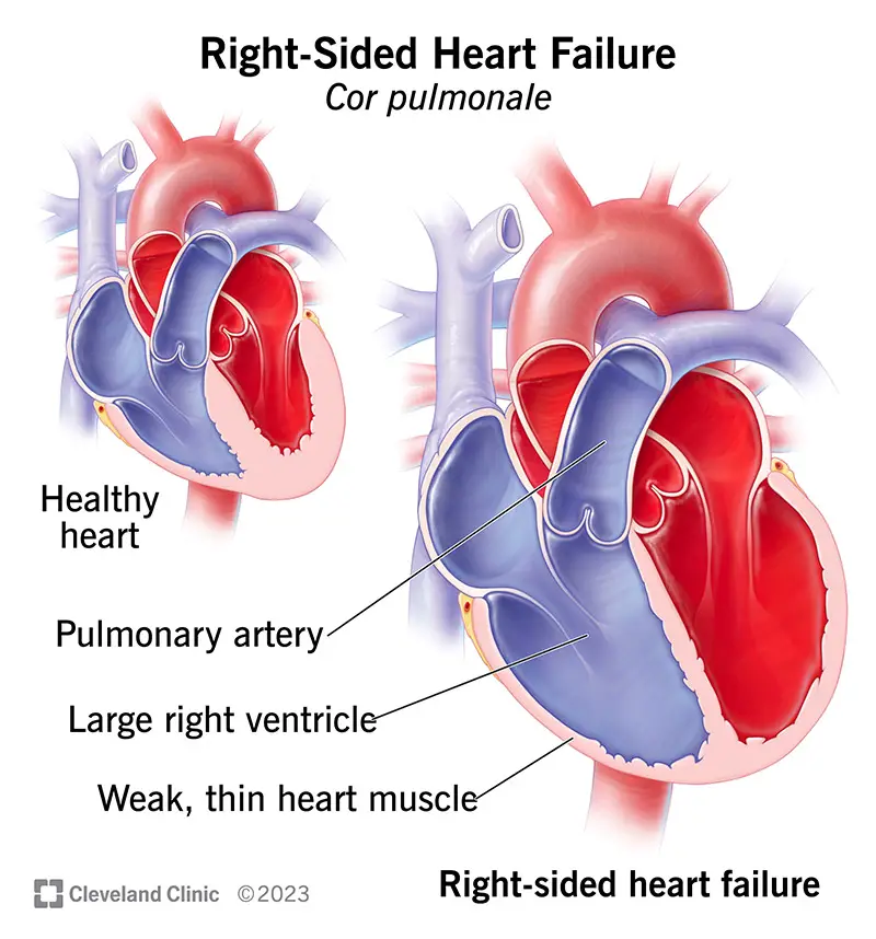 24922 right sided heart failure