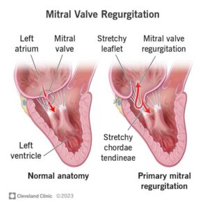 24983 mitral valve regurgitation.ashx