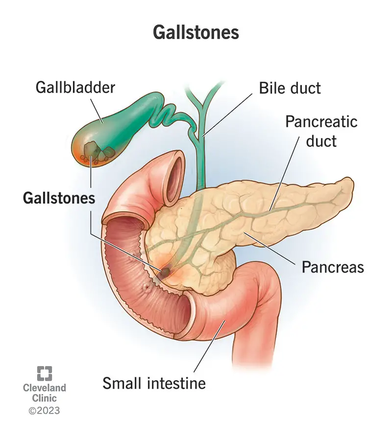 7313 gallstones