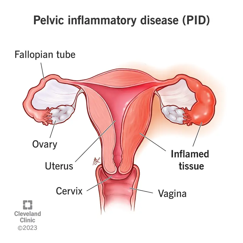 9129 pelvic inflammatory disease pid