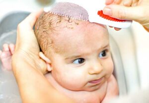 Baby Cradle Cap 503200856 770x533 1