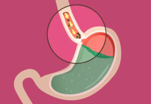 achalasia Illst 525226320 770x553