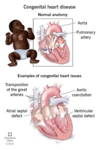 congenital heart disease