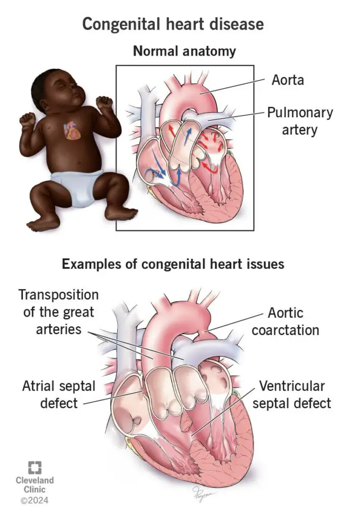 congenital heart disease