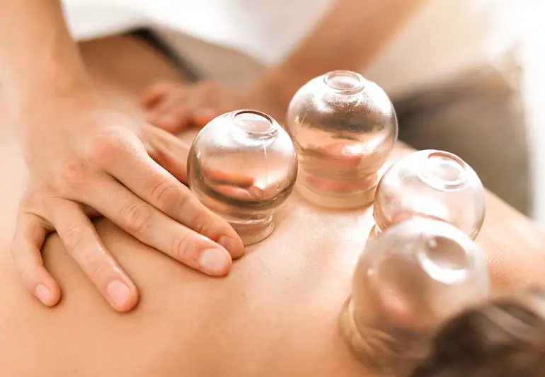 cuppingTherapy 1246919695 770x533 1