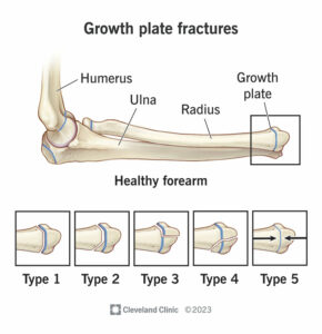 growth plate fractures