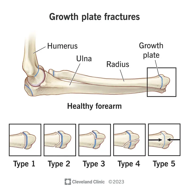 growth plate fractures