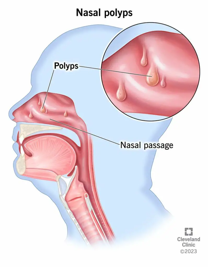 nasal polyps