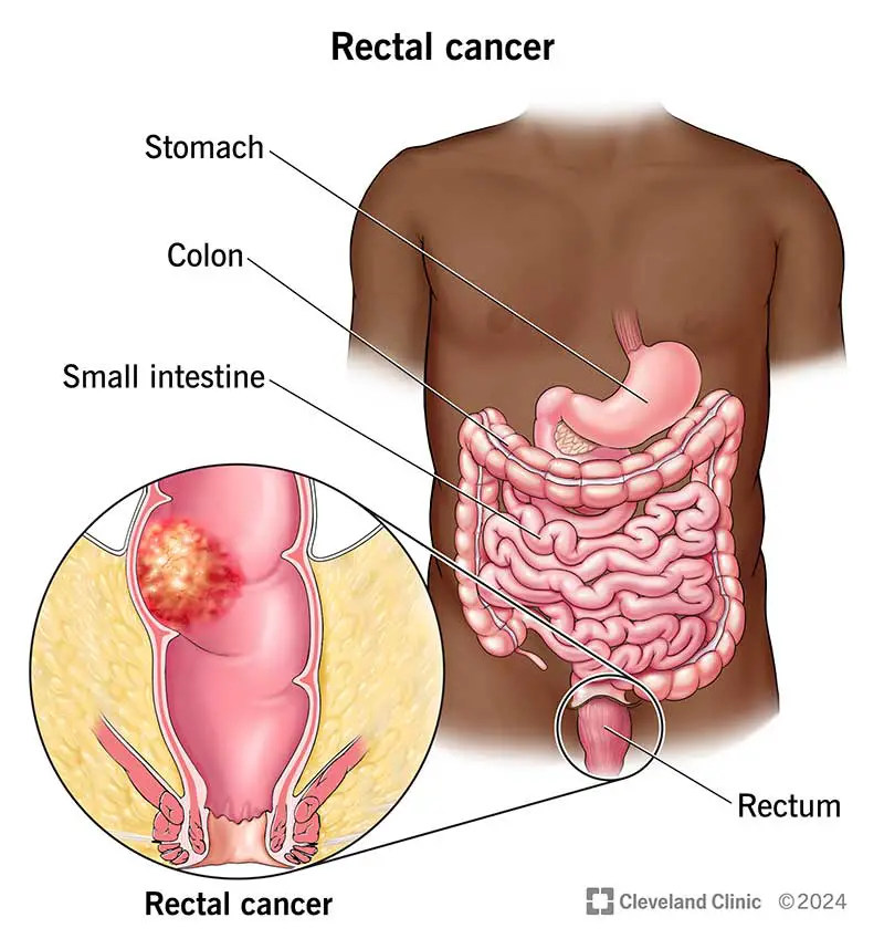 rectal cancer