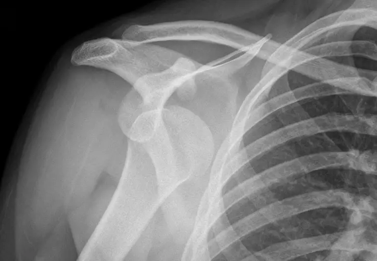 shoulderDislocatedXray 183212469 770x533 1