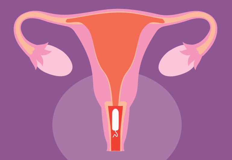 tampon in uterus 1253922218 770x533 1