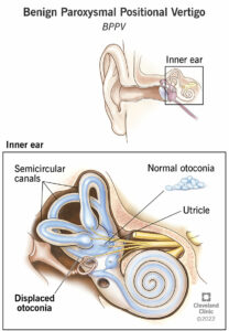 11858 benign paroxysmal positional vertigo