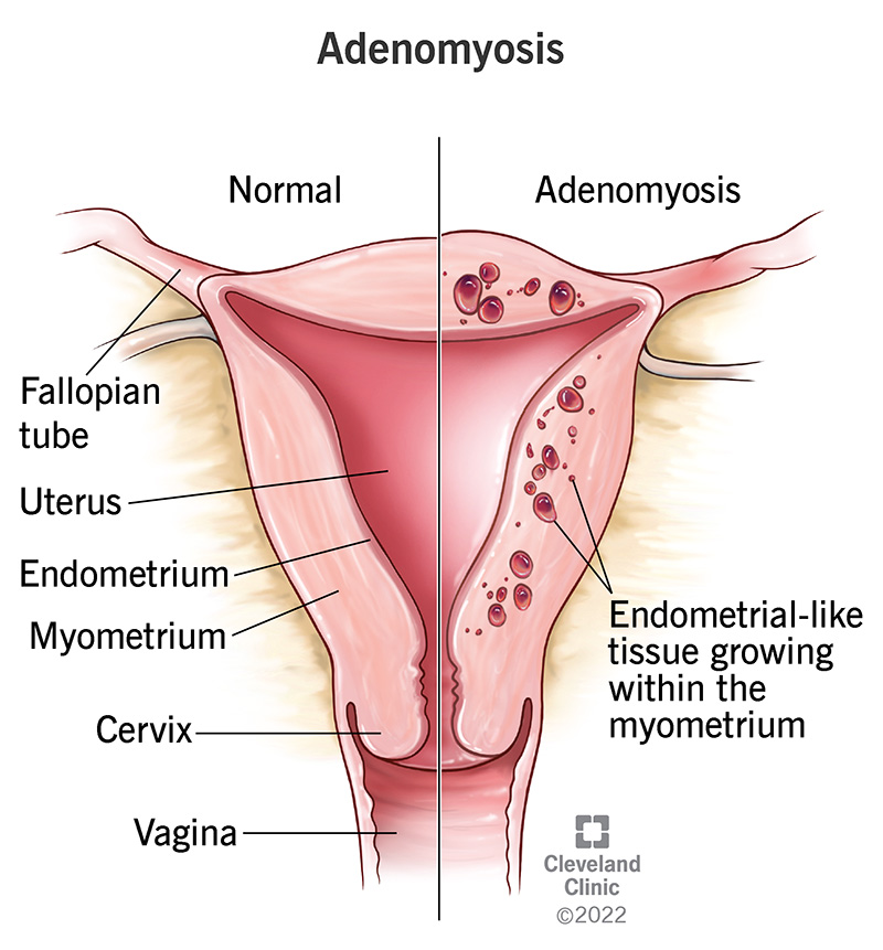 14167 adenomyosis