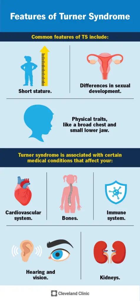 15200 turner syndrome