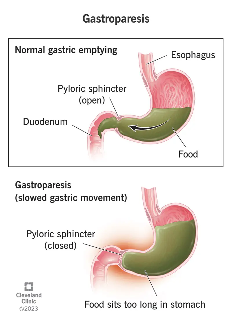 Gastroparēzes gadījumā pārtika normāli nepārvietojas caur vēderu.