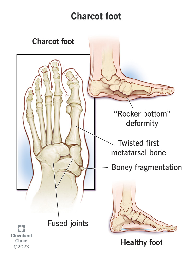 Charcot pēda var izraisīt nopietnas komplikācijas, ja tā netiek nekavējoties ārstēta.