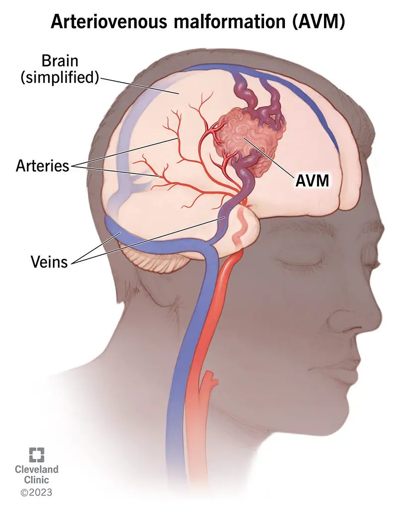 Arteriovenoza malformācija izskatās kā vairāki asinsvadi, kas savijušies kopā.