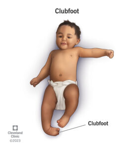 16889 clubfoot