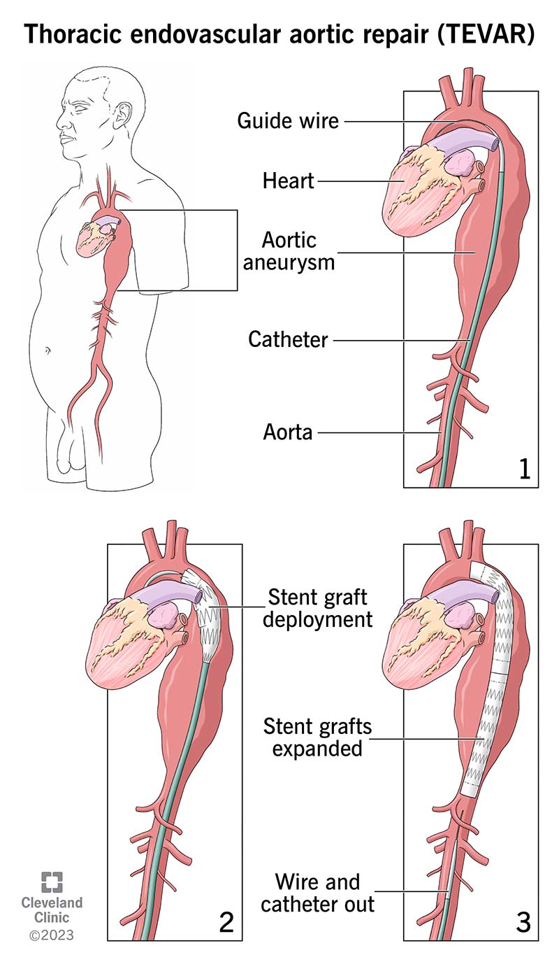 Jūsu pakalpojumu sniedzējs izmanto katetru, lai ievadītu stentu aortā un labotu aneirismu.