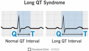 17183 long qt syndrome