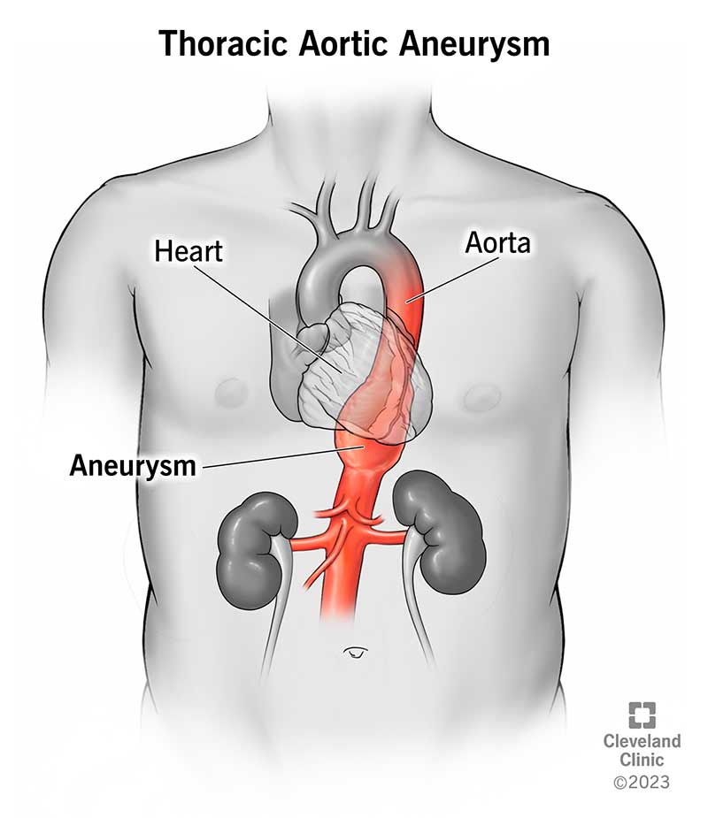 17552 thoracic aoritc aneurym illustration