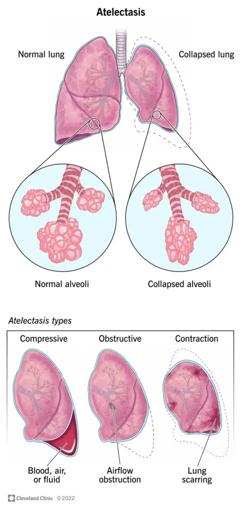 17699 atelectasis