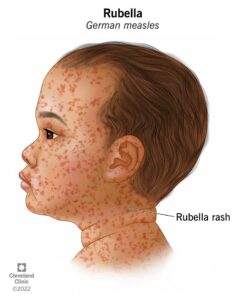 17798 rubella