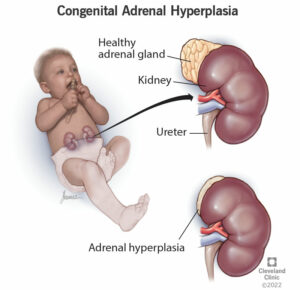 17817 congentital adrenal hyperplasia