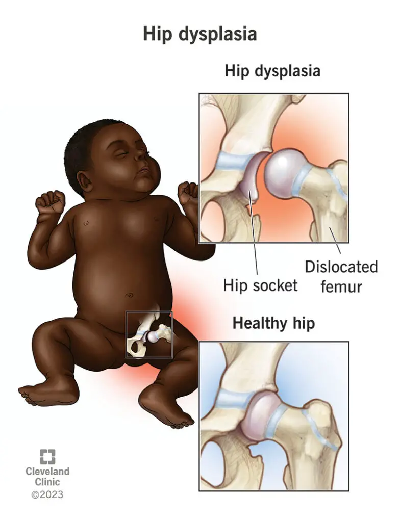 17903 hip dysplasia 2