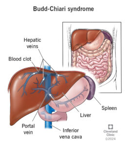 21097 budd chiari syndrome