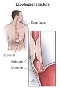 21456 esophageal stricture