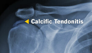 21638 Calcific Tendonitis