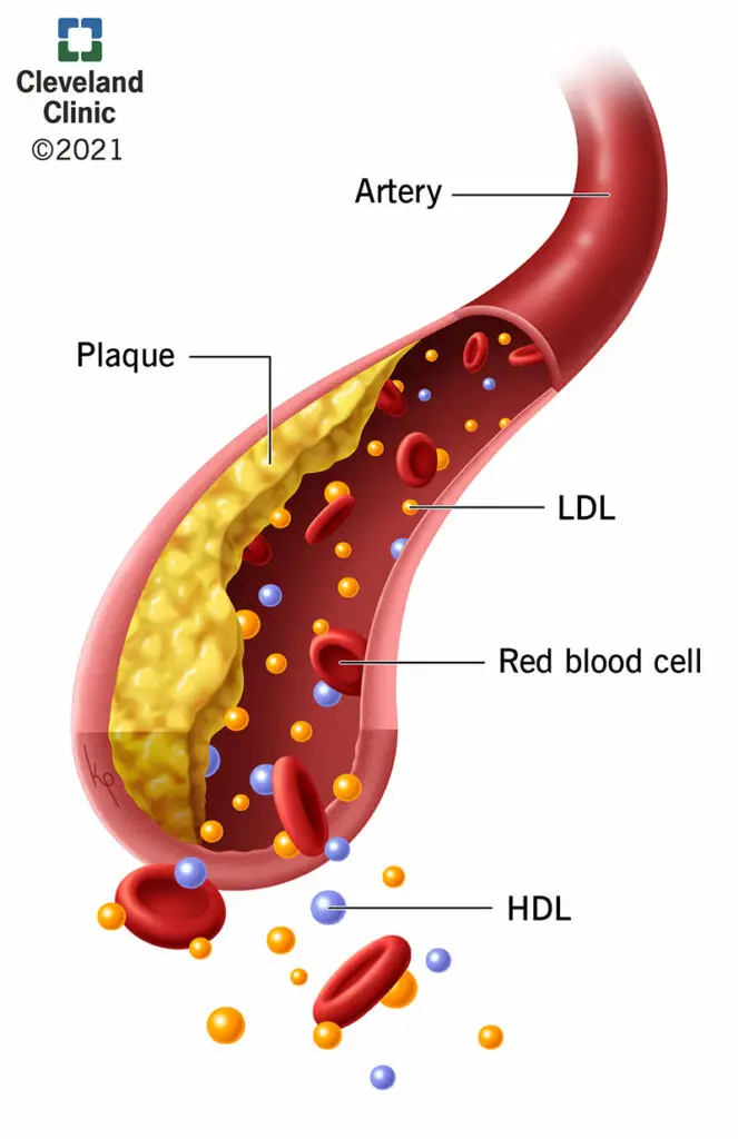 21656 hyperlipidemia illustration.aspx .ashx