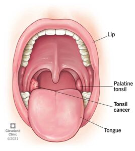 21931 tonsil cancer