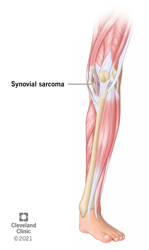 22012 synovial sarcoma